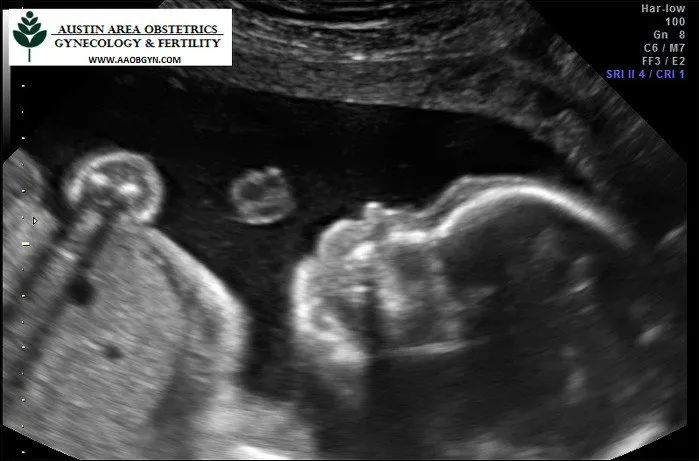 Baby Highland Ultrasound